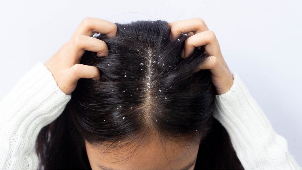 Rambut Berketombe Disebabkan oleh hal Sederhana