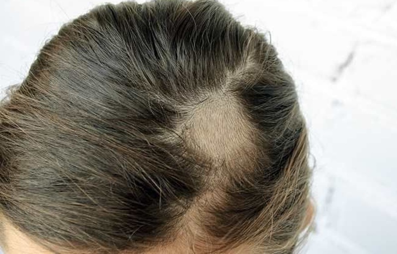 Ilustrasi rambut rontok