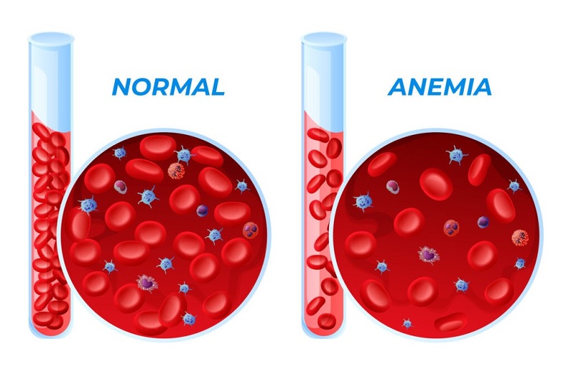 Ilustrasi Anemia