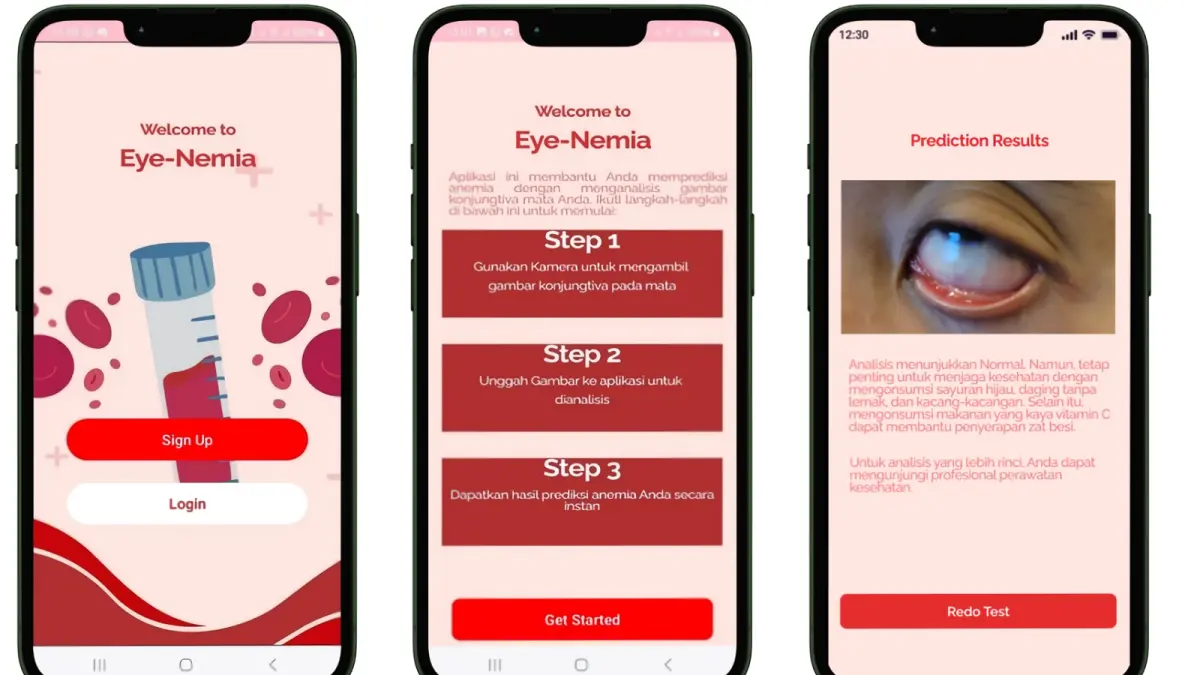 Cek Anemia Kini Cukup Pakai Kamera HP Berkat Inovasi AI Dosen UMM