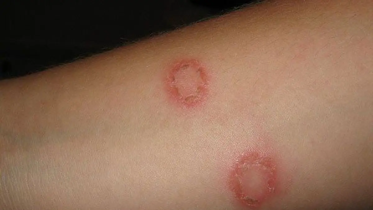Ringworm disebabkan oleh infeksi gamur dan menimbulkan ruam kemerahan yang terasa gatal. (Pinterest/alexandraclaytonn28).