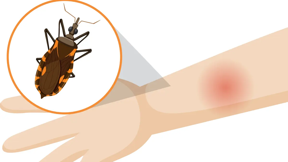 Penyakit chagas disebabkan oleh serangga triatomine yang menularkan parasit sehingga menimbulkan beberapa gejala pada tubuh manusia. (Magnific).