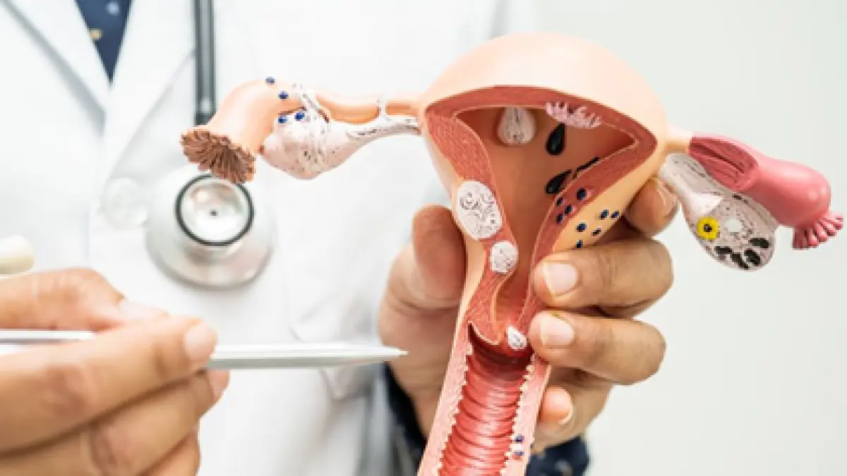 AKTIF SKRINING: Gambaran kanker leher rahim atau kanker serviks (ilustrasi: australian center for the prevention of cervical cancer)