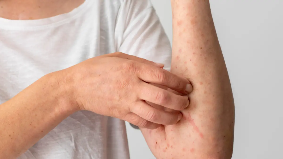 Dermatitis ditandai dengan kulit terasa gatal dan kemerahan. (Magnific).