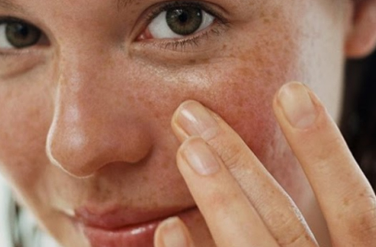 Ilustrasi flek hitam pada wajah istimewa)