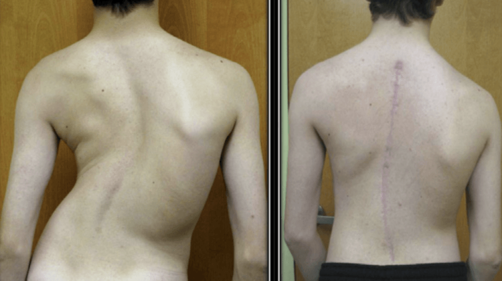 Ilustrasi kelainan tulang belakang skoliosis