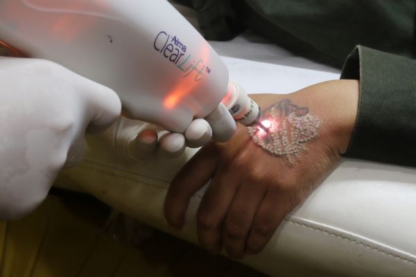 Proses menghapus tato gratis yang dilakukan di MS Glow Aesthetic Clinic. (Darmono/Radar Malang