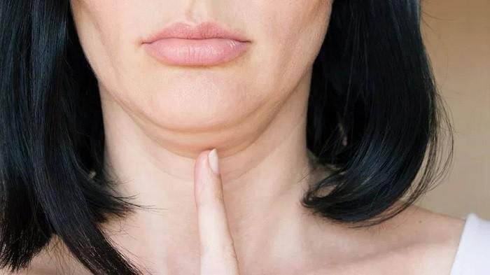 Double chin bisa disebabkan faktor genetik, kulit yang kendor, usia, dan postur. (Shutter Stock/ist)
