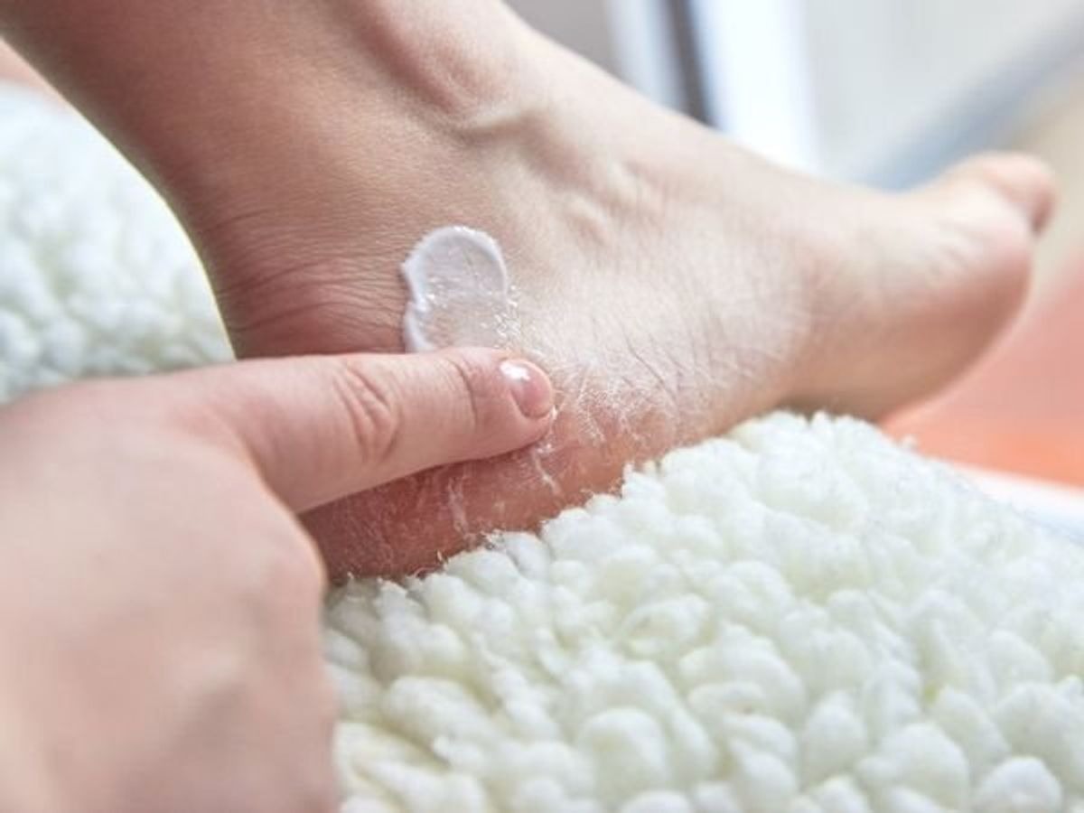 Pecahnya kulit tumit kaki tak hanya mengganggu penampilan dan tidak nyaman saja, tapi dapat menyebabkan komplikasi hingga pendarahan. (Getty Images/ist)
