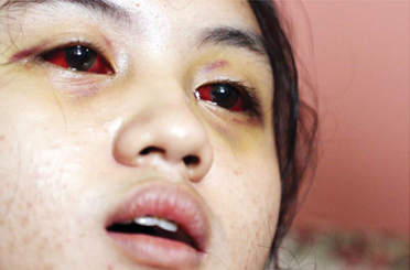 MATA MERAH: Mata Cahayu Nur Dewata tampak sangat merah hingga kemarin. Dia sempat koma selama tiga hari dan mengalami pendarahan otak hingga susah mengingat banyak kejadian. (DARMONO/RADAR MALANG)