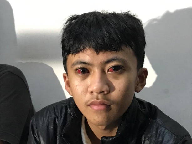 BELUM PULIH: Mata Raffi Atha Dziaulhamdi, 14, masih memerah akibat paparan gas air mata dari tragedi kanjuruhan. (ADITYA NOVRIAN/RADAR MALANG)