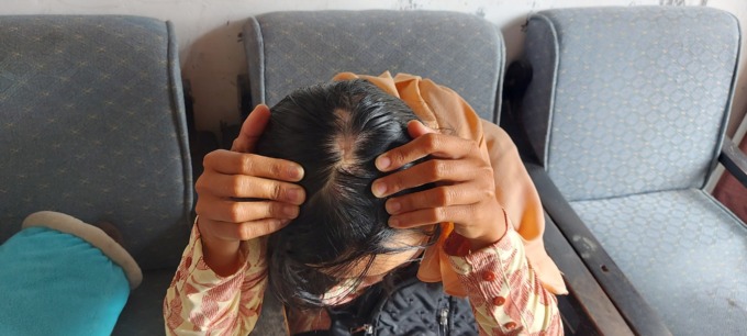 BENJOL: FS menunjukkan bagian tengah kepalanya yang dipukul AS kemarin. Di bagian itu pernah dilakukan operasi buka tengkorak akibat  kecelakaan pada 2012 silam.  (BIYAN MUDZAKY HANINDITO/RADAR MALANG)