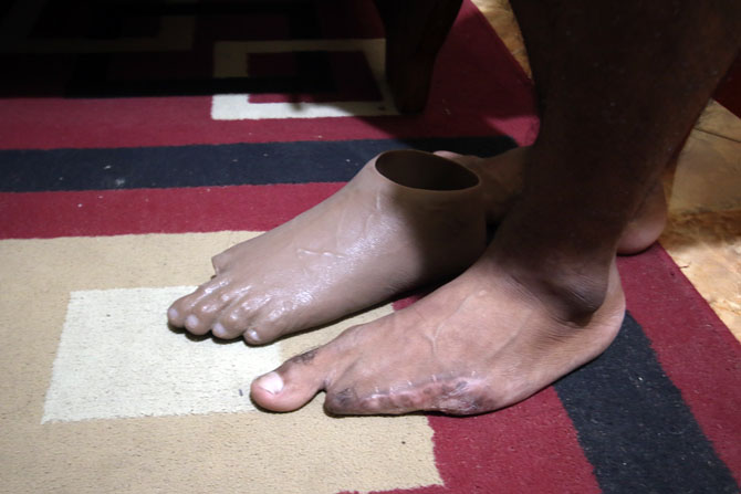 PUTUS : Jari kaki seorang karyawan pabrik kaca yang tersisa jempol akibat kecelakaan kerja. (Darmono/Radar Malang)