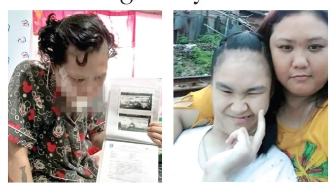 BERUBAH DRASTIS: Kondisi Dewi Kusumawati pasca mengidap kanker lidah. Foto kanan, Dewi berfoto bersama putrinya ketika masih sehat.(Kolase Nabila Amelia / Radar Malang – Dewi Kusumawati For Radar Malang)