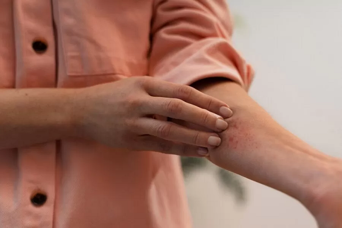 LUPUS: Penyakit reumatik autoimun yang menyerang berbagai macam organ yang dibarengi beragam gejalanya. (dok. Jawa Pos)