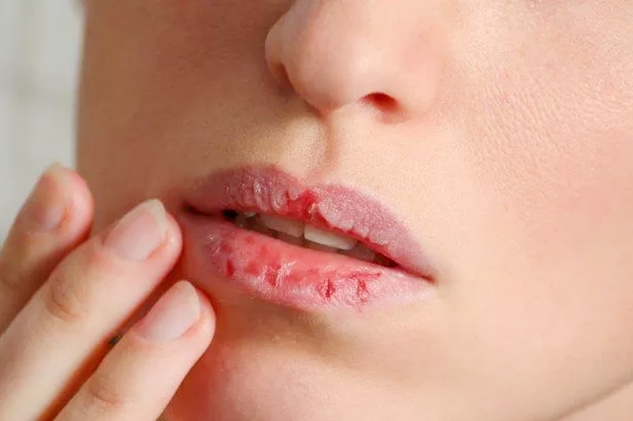 Mengelupas kulit bibir tanda gangguan kesehatan mental.