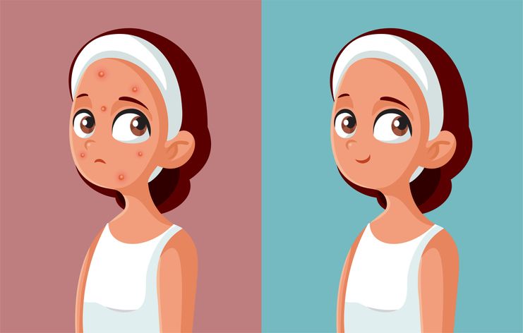 Selain skincare, makanan juga dapat menghilangkan jerawat dari dalam.