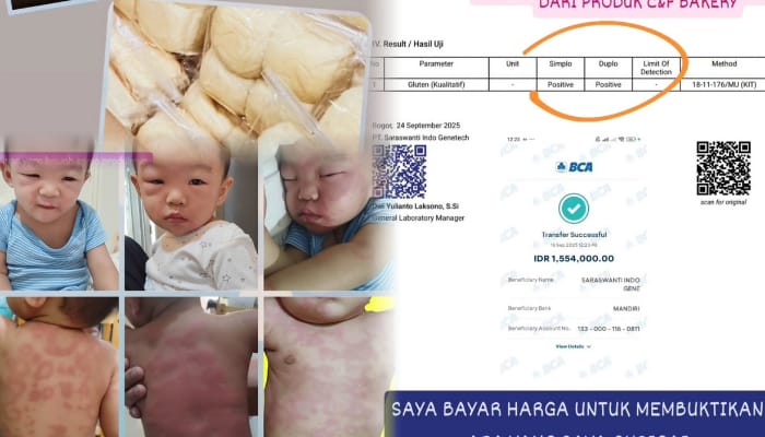 Balita mengalami reaksi alergi berat setelah mengkonsumsi roti