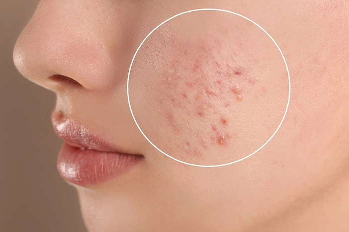 Di tengah gempuran produk skincare yang menjanjikan hasil instan, memilih solusi yang benar-benar efektif dan tetap ramah di kantong. Sumber foto: Google
