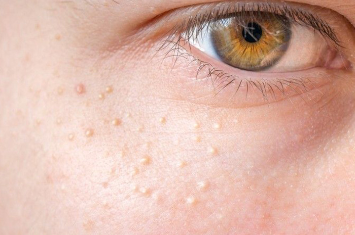 Bagi banyak orang, munculnya bintik putih kecil di wajah sering dianggap sebagai komedo atau jerawat yang membandel. Sumber Foto: Pinterest
