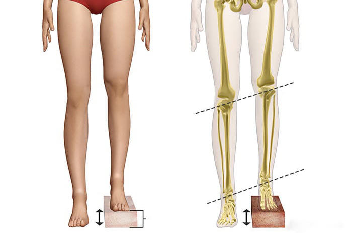 Perbedaan panjang tungkai adalah kondisi ketika satu kaki lebih panjang atau lebih pendek dibanding kaki lainnya. Sumber Foto: Google