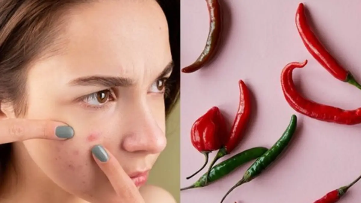 Konsumsi Makanan Pedas Bisa Memicu Jerawat? Simak Penjelasan berikut