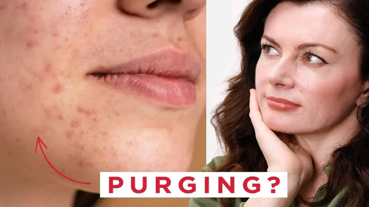 Purging terjadi karena bahan aktif dalam skincare mempercepat proses regenerasi kulit. 