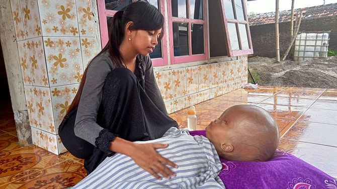 pengobatan-bayi-hidrosefalus-dinkes-cuci-tangan