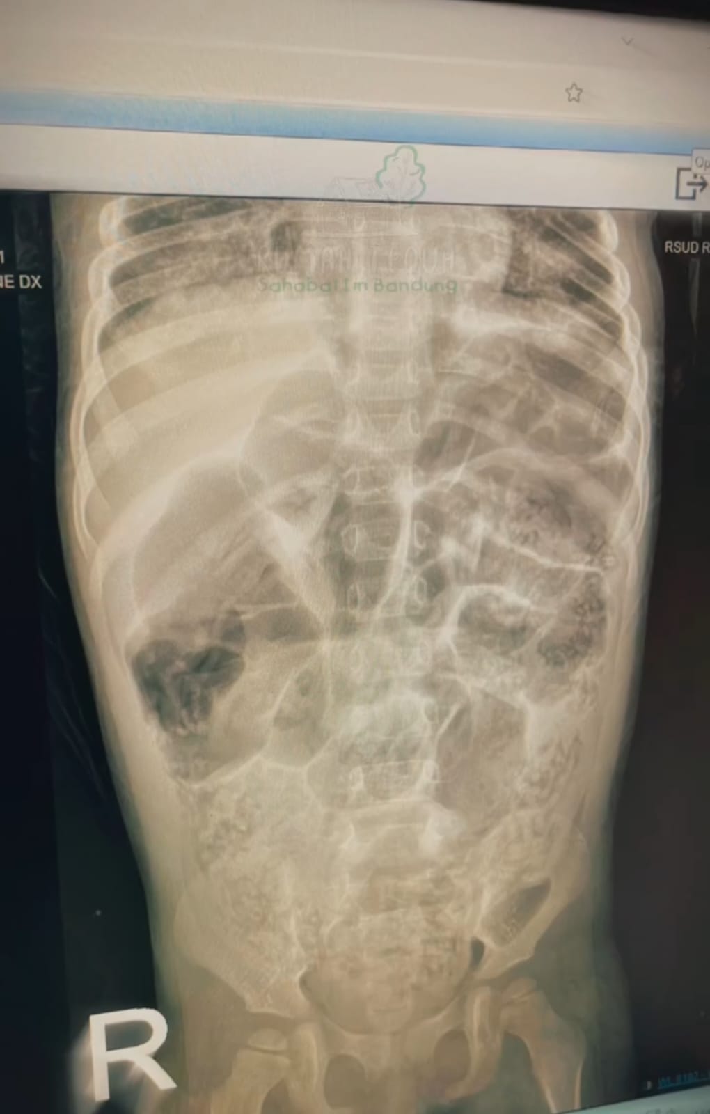 Tampilan CT Scan tubuh Raya. Bayi berusia 4 tahun yang tewas karena infeksi cacing gelang.