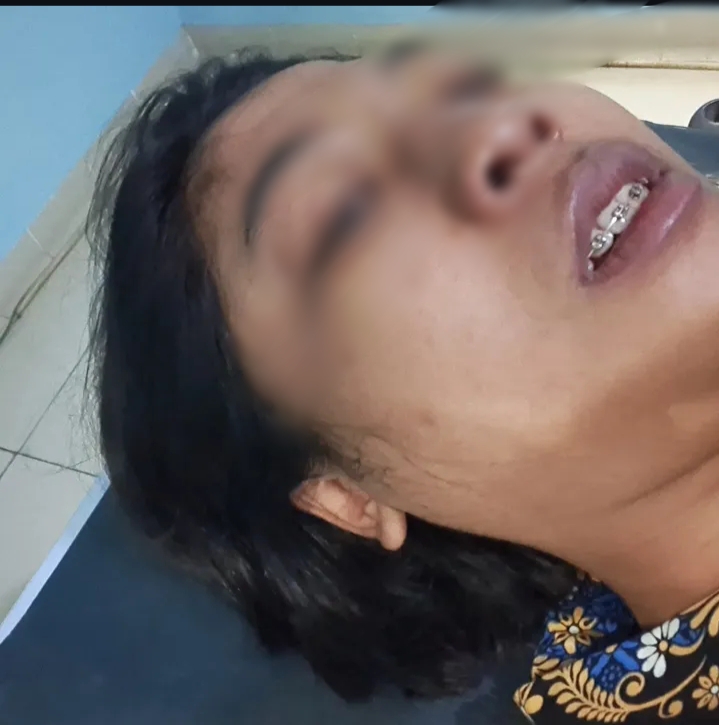 KORBAN PENGANIYAYAN: Seorang perempuan inisial DRA pegawai ASN Pemkab Gresik alami luka patah tulang hidung usai alami dugaan kasus penganiyaan oleh temen kantornya seorang laki - laki inisial SB.