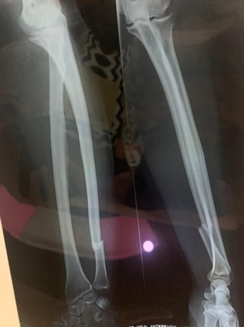 PATAH TULANG: Foto ronsen tangan korban Christian Andreas karena dipukul kayu pelaku yang merupakan tetangganya sendiri diduga mengalami gangguan jiwa. (Ist/Radar Gresik)