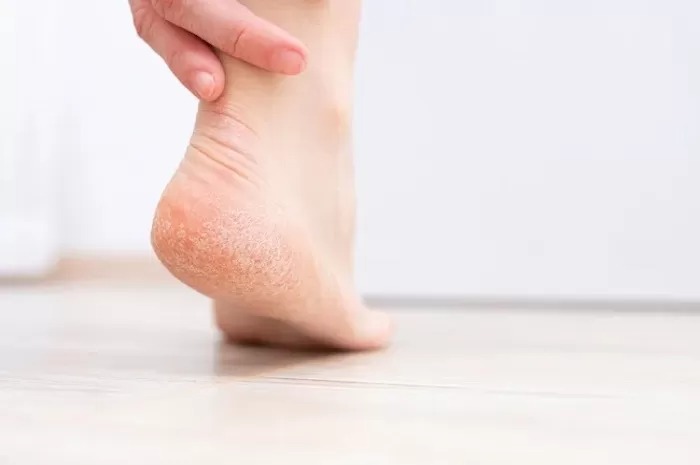 Masalah : Kulit kaki kering dan mengelupas