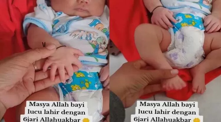 Bayi berjenis kelamin perempuan di Madura memiliki 6 jari di kedua tangan dan kakinya.