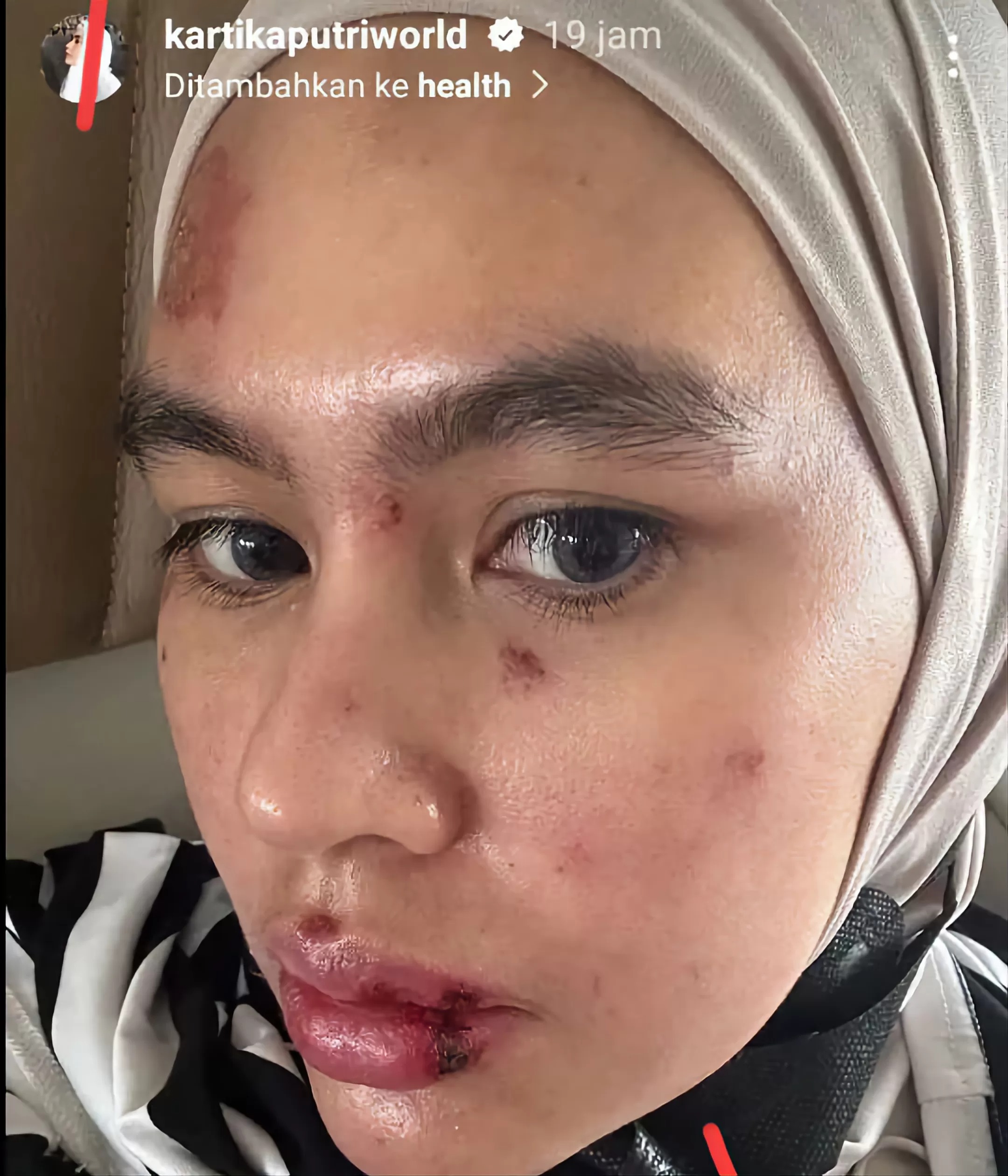 Kondisi Kartika Putri saat diupload di akun pribadinya.