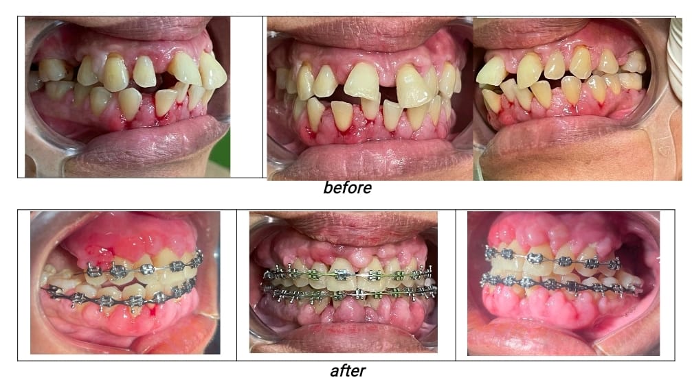 Kasus Maloklusi Kelas I Tipe I : Diastemata (penggunaan obat dalam jangka waktu lama, obat epilepsy, hipertensi) Foto Intraoral (Tampak Samping Kanan, Depan, Samping Kiri)