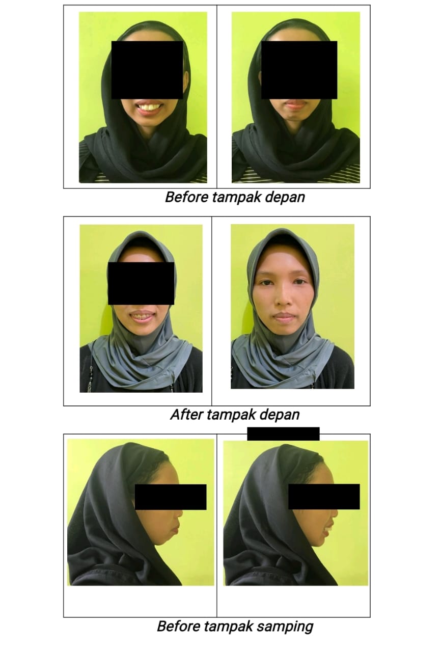 Tipe 2 : Protrusi Rahang Atas