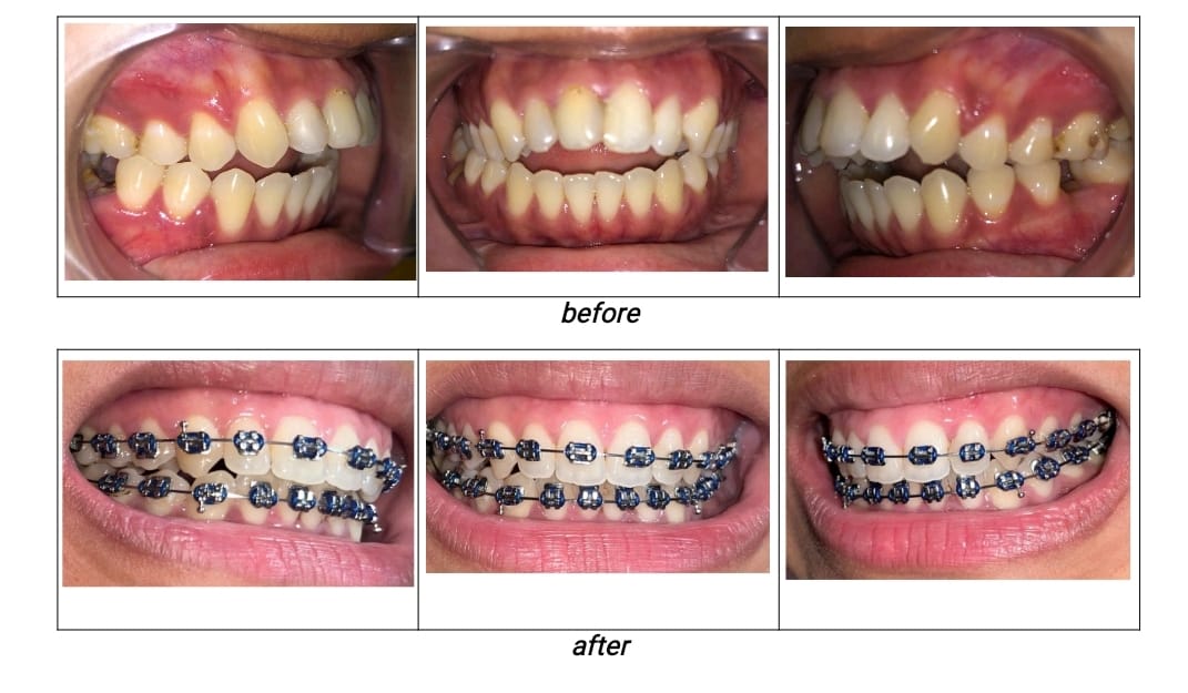 Kasus Maloklusi Kelas II Divisi I : Openbite dan Protrusi Anterior Maksila Foto Intraoral (Tampak Samping Kanan, Depan, Samping Kiri)