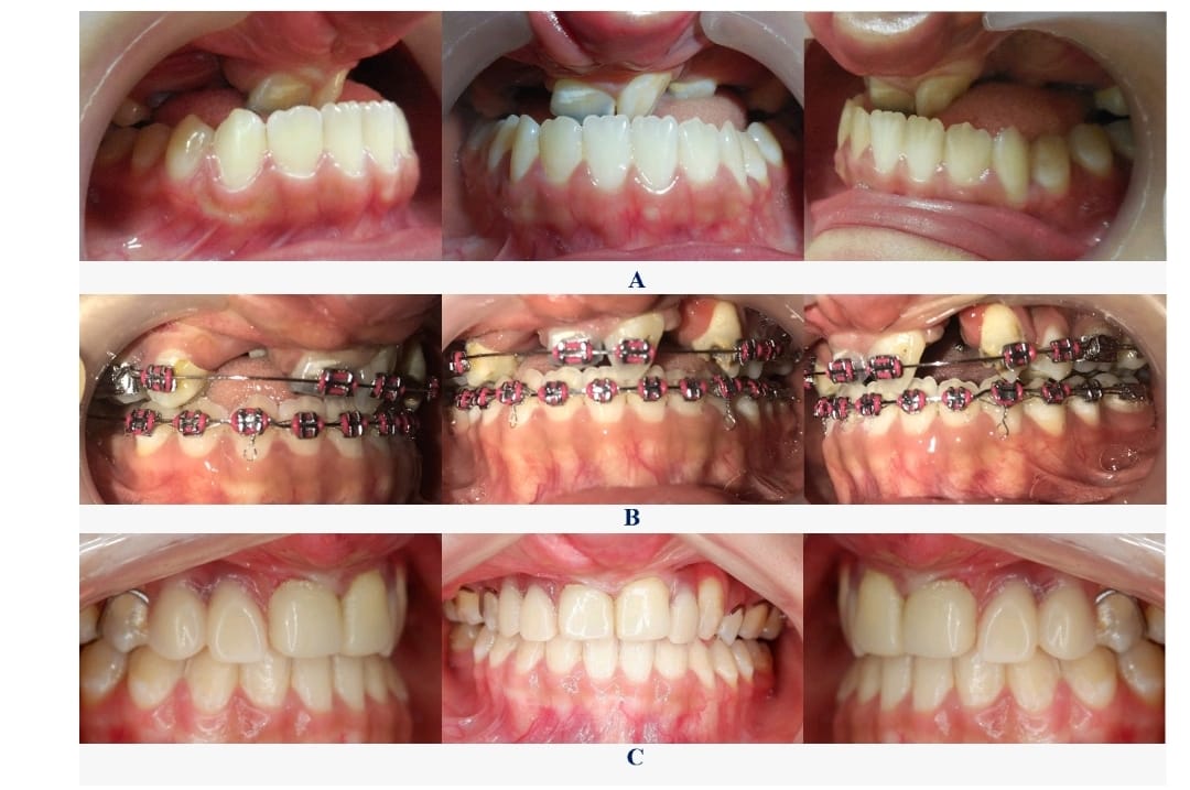 Kasus Maloklusi Kelas III Tipe True Class III : Etiologi Lip and Cleft Palate  Foto Intraoral (Tampak Samping Kanan, Depan, Samping Kiri)