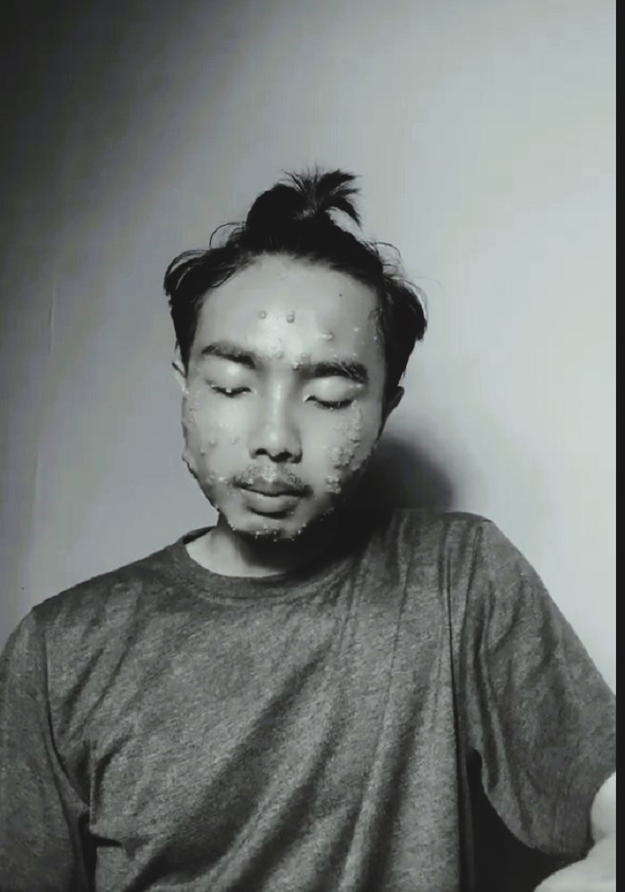Pria yang terkena molluscum atau bintil-bintil di wajah.