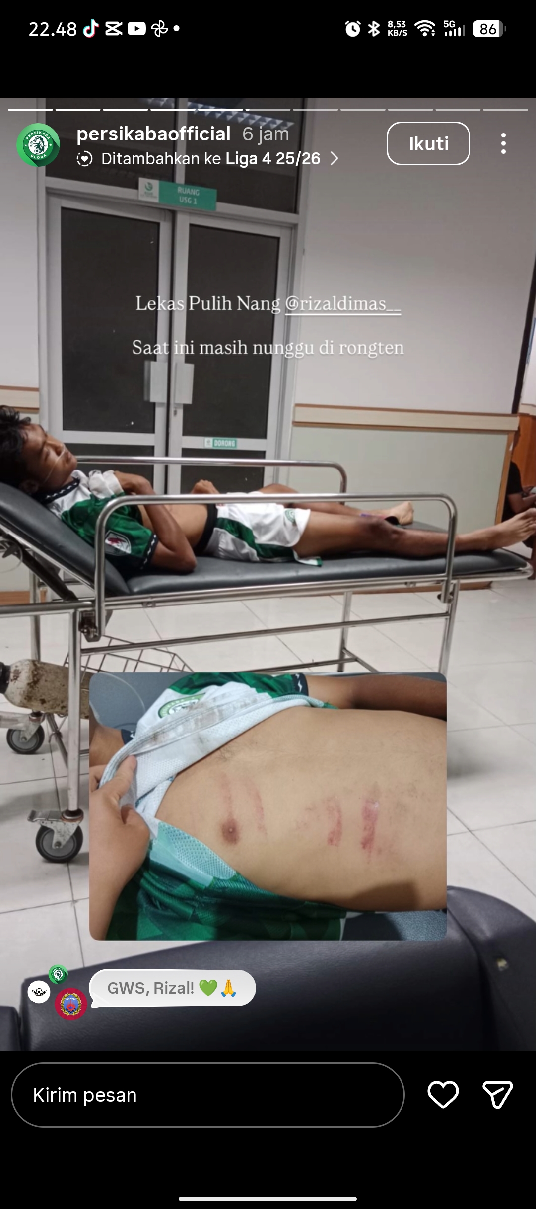 Kondisi badan pemain Persikaba Blora Rizal Dimas yang sempat mendapat tendangan kungfu dari kiper PSIR Rembang (21/1/2026)