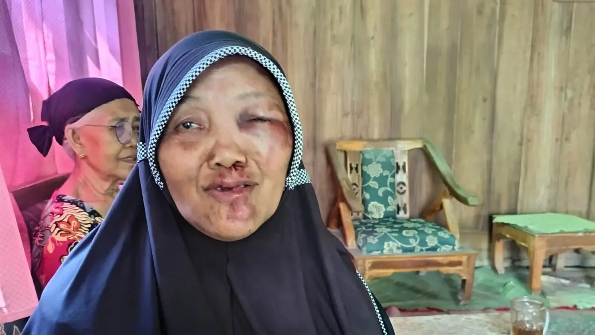 Painem, warga Paingan, Desa Plumbon, Kecamatan Sambungmacan, Sragen mengalami luka setelah terjungkal karena kabel wifi menjuntai, Selasa (21/4/2026) dini hari. (Ahmad Khairudin/Radar Solo)