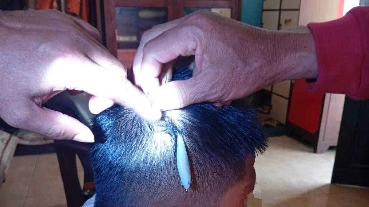 Mata pancing yang tertancap di kepala S, remaja warga Wonogiri Kota. (DOK.DAMKAR WONOGIRI)