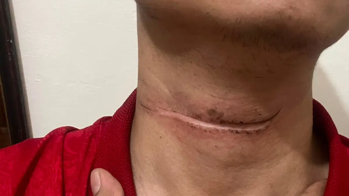 Aritio Sandi, 30, warga Dukuh Kedunguter, Desa Pendem, Kecamatan Sumberlawang, Sragen terjerat kabel fiber optik di Gemolong. (Ahmad Khairudin/Radar Solo)