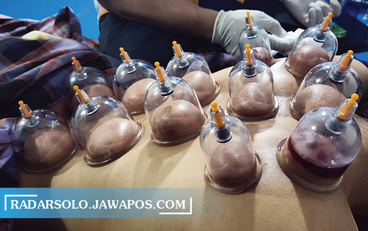 AMAN: Terapi bekam kini mulai banyak diminati berbagai kalangan termasuk pejabat. (IWAN KAWUL/RADAR SOLO)