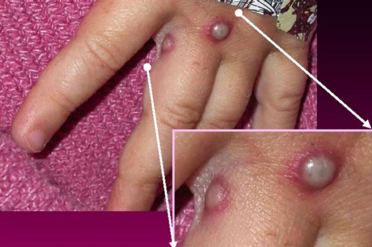 Ilustrasi seseorang terkena cacar monyet. Ternyata cacar monyet berbeda dengan cacar biasa atau smallpox. (CDC)