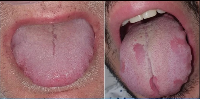 Ilustrasi sariawan di lidah (Nuno-Gonzalez et al/British Journal of Dermatology)