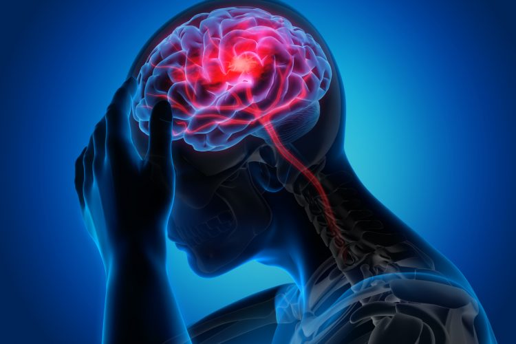 Ilustrasi otak manusia. Sejumlah penyakit juga bisa dialami otak salah satunya tumor hingga stroke. (Carrus Health)
