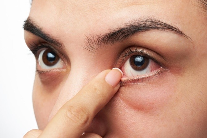 ILUSTRASI. Mata kering. (DLife)