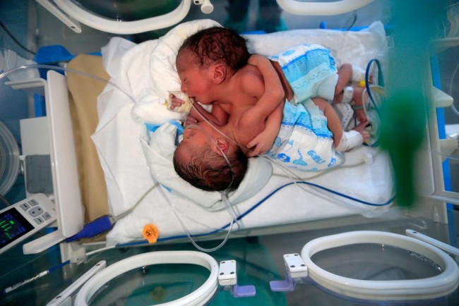 Bayi kembar siam dari ayah berbeda. (MOHAMMED HUWAIS/AFP via Getty Images)