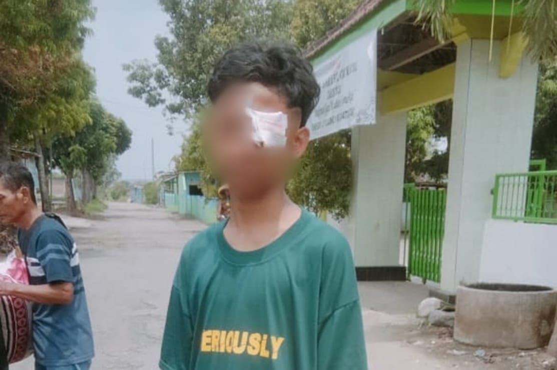 DCS, korban pengeroyokan gangster yang menderita luka pada bagian mata sebelah kiri.